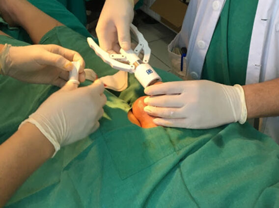 bệnh nhân dài bao quy đầu được cắt bằng máy cắt bao quy đầu nhanh chóng an toàn tạo hình đẹp và không đau nhanh phục hồi