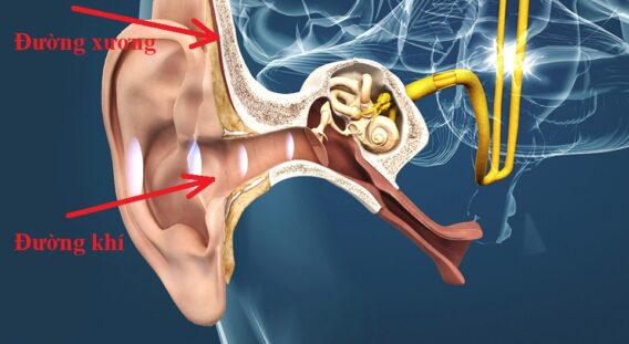 Máy Trợ Thính Đường Xương