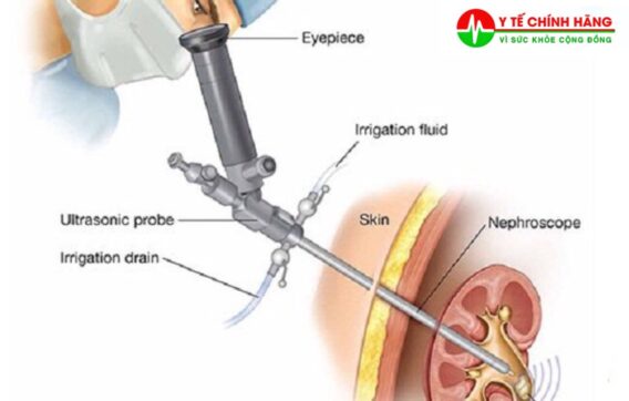 Đòi hỏi mức đào tạo của bác sĩ: Để đảm bảo có thể thực hiện tốt, bác sĩ cũng như kíp mổ cần được đào tạo bài bản, rèn luyện tốt về kỹ thuật và chiến thuật để đạt hiệu quả cao.