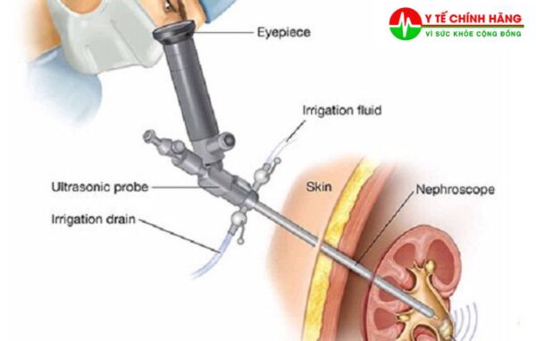 ytechinhhang bo nong than tan soi qua da mini pcnl1