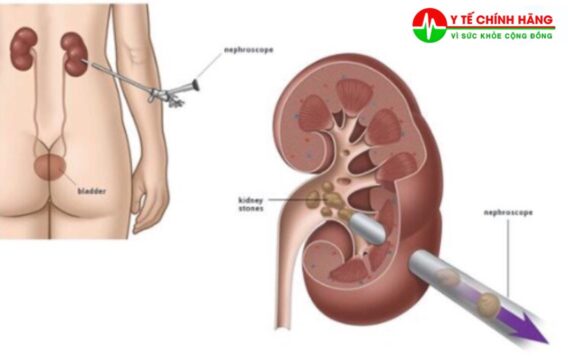 Tiết kiệm thời gian và tiền bạc: Là phương pháp ít gây đau nên bệnh nhân sau khi được tán sỏi không cần phải nằm viện quá lâu, có thể sớm quay lại với đời sống sinh hoạt hằng ngày.