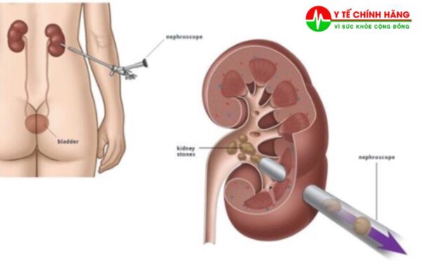 Bộ Nong Thận Tán Sỏi Qua Da MINI PCNL