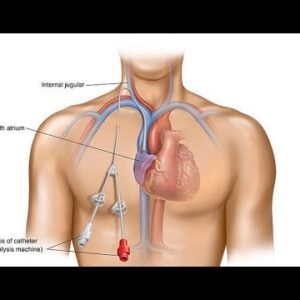 Catheter Ống Thông Y Tế