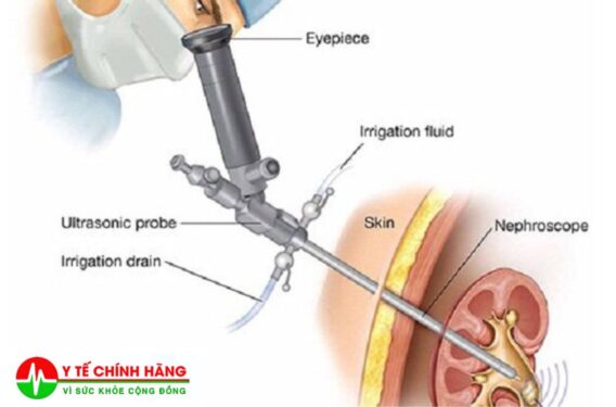 Nội Soi Tán Sỏi Thận Qua Da