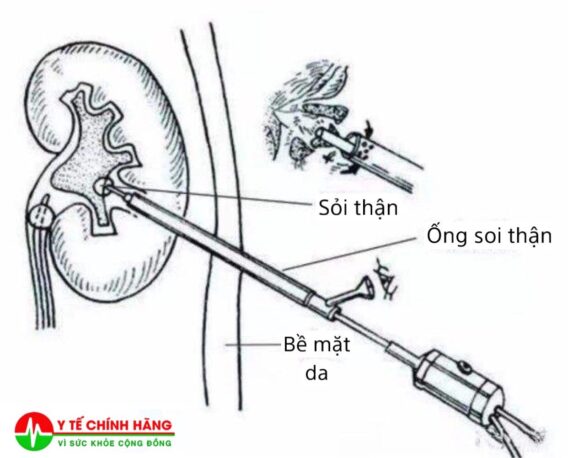 Quy Trình Phẫu Thuật Nội Soi Tán Sỏi Thận Qua Da