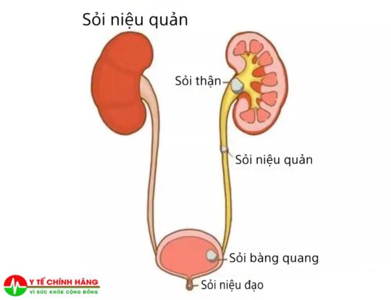 Phân Loại Sỏi Tiết Niệu