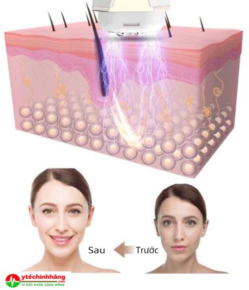 Tần số vô tuyến RF chống lão hóa một cách thần kỳ