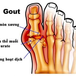 Bệnh Gout thường được chia thành giai đoạn cấp tính, giai đoạn gián đoạn và giai đoạn mãn tính, nhiệt độ nước ngâm chân ở các giai đoạn khác nhau là khác nhau.