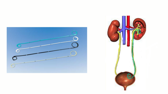 Lưu Ý Khi Đặt Stent Niệu Quản