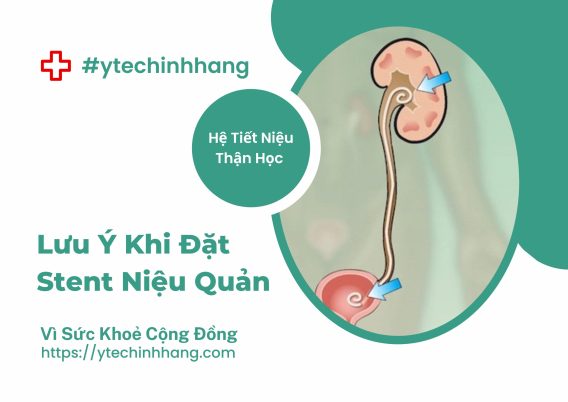 Lưu Ý Khi Đặt Stent Niệu Quản