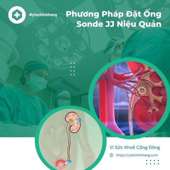 Phương Pháp Đặt Ống Sonde JJ Niệu Quản