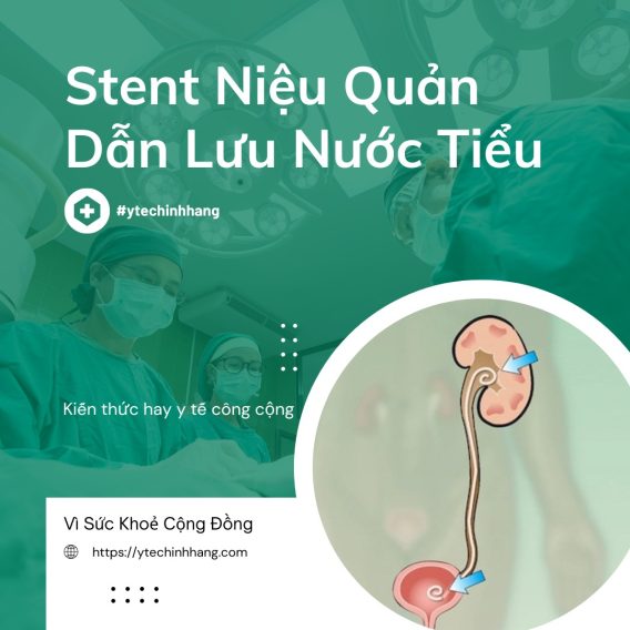 Stent Niệu Quản Dẫn Lưu Nước Tiểu