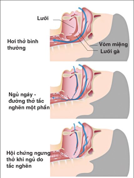 Phỏng Vấn Bệnh Nhân Tăng Huyết Áp Tập 1