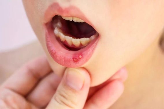 Nóng Trong Người: Đâu Là Giải Pháp Triệt Để? 12 Nóng Trong Người: Đâu Là Giải Pháp Triệt Để?